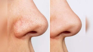 Blackhead Breakthrough: The Simple Towel Trick Dermatologists Don't Want You to Know