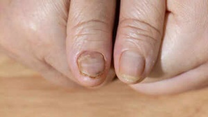 Fragile Nails: When Brittle Nails Signal a Deeper Health Issue