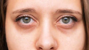 Dark circles under eyes? These vitamin deficiencies could be the cause