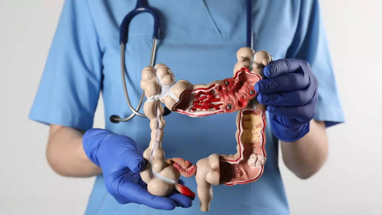 Colon cancer early signs: 8 symptoms you should never ignore